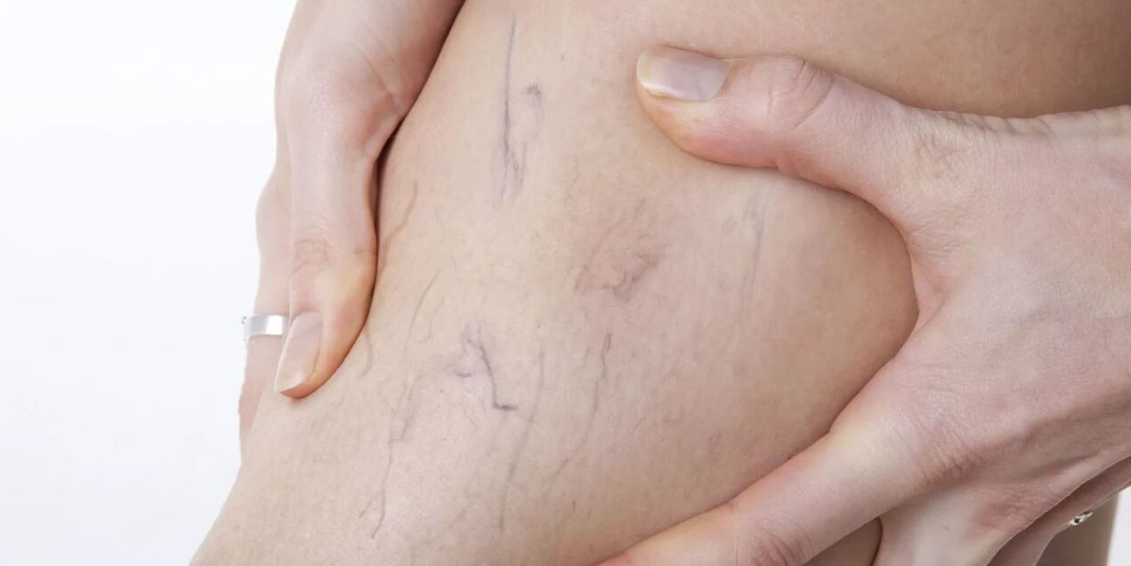 Пред употребата на крем од варикон